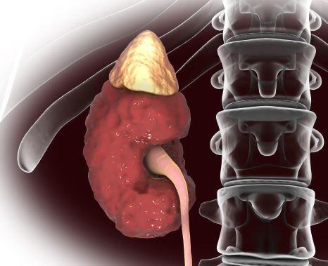 CKD Patients with STEMI: High-risk yet Under the Radar