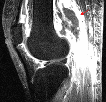 diabetic myonecrosis