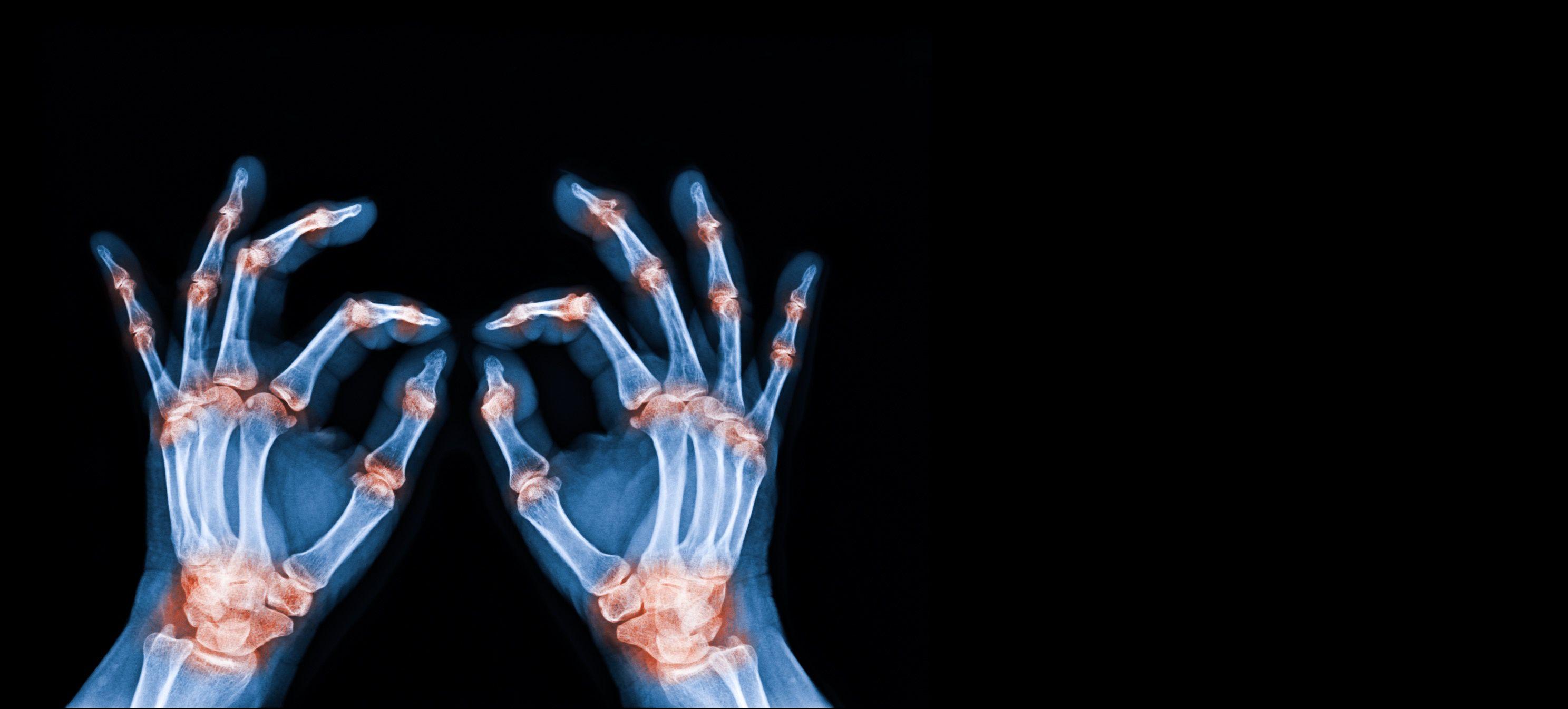 rheumatoid arthritis treatment