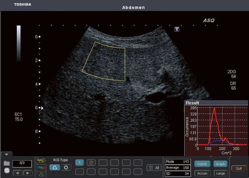 Test Monitors Fibrosis in Women With Psoriasis