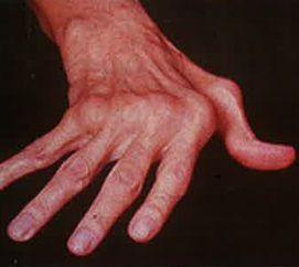 Rheumatoid Arthritis Risk Report: 5 Pluses and Minuses