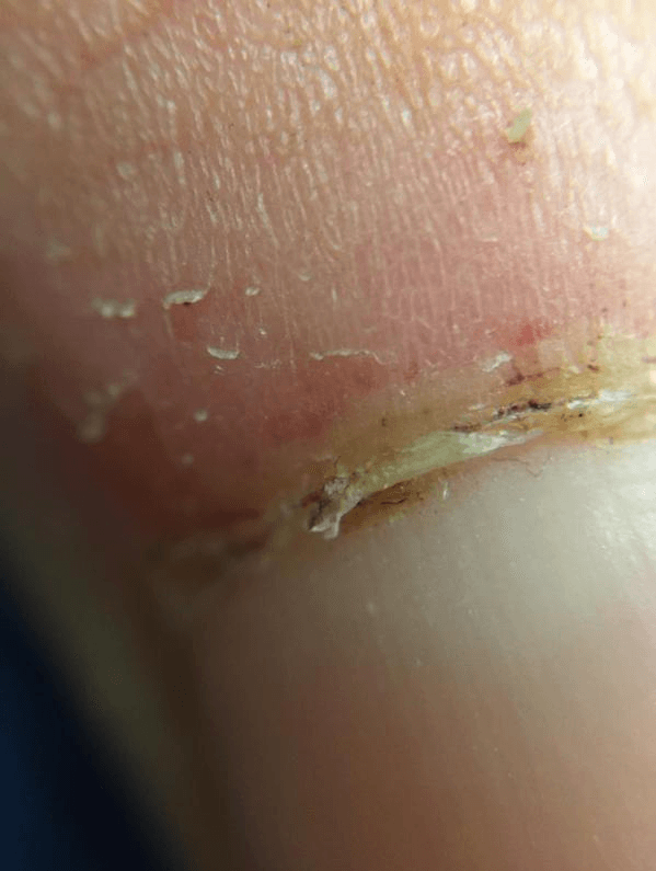 Can IPhone Match Dermatoscope for Nailbed Exams?