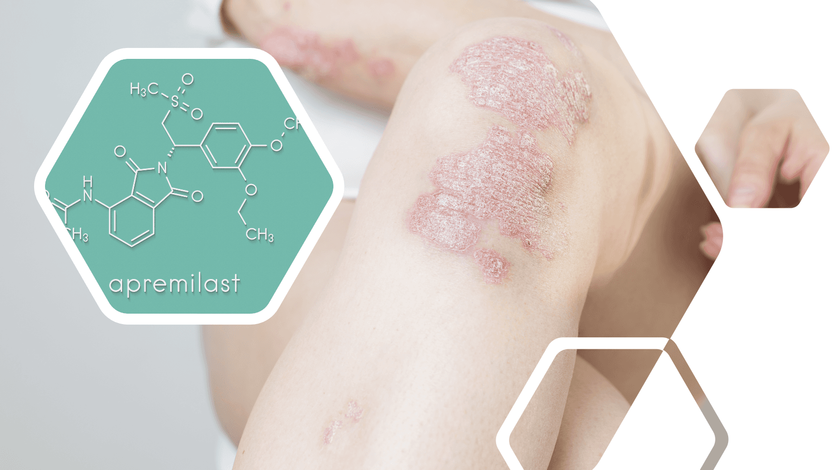 Apremilast Monotherapy Proves Effective Treatment for Psoriatic Arthritis