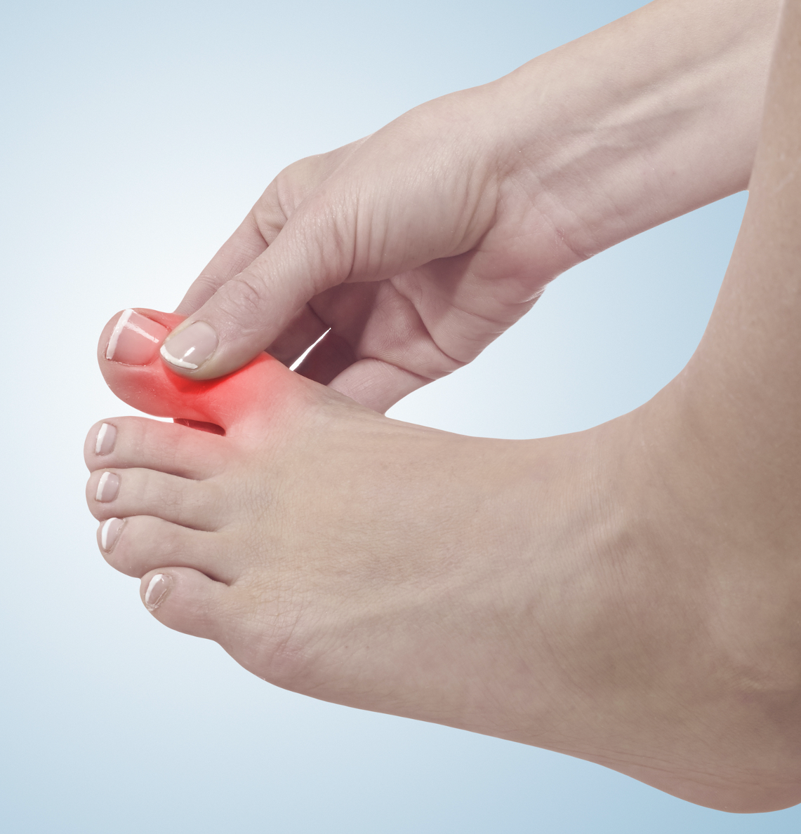 Gout Prevalence Estimated to Increase More Than 70% by 2050 