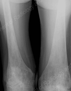 Bilateral Knee Pain in a 55-Year-Old Man