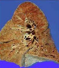 Lung Disease in Scleroderma, Part II:  Vital Basics About PAH