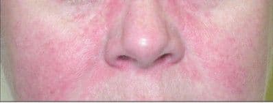 Heliotrope rash in dermatomyositis