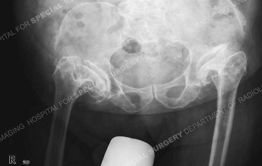 82-Year-Old Man With Bilateral Hip Pain