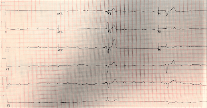 EKG printout from patient experiencing bradycardia.