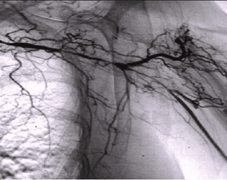 Long-Term Rituximab Gets the Job Done in Vasculitis