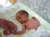 Preemies at Higher Risk for Psychiatric Disorders as Teenagers