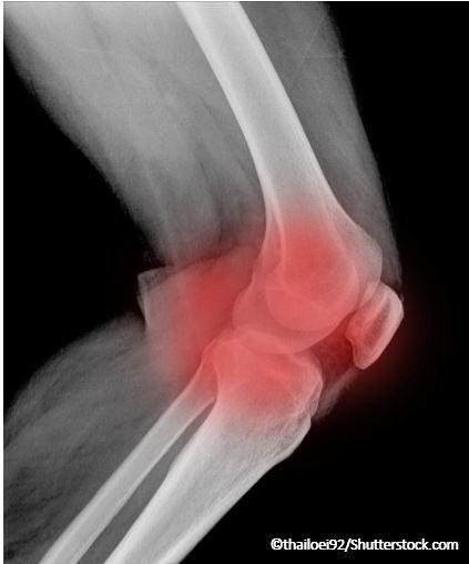 Garlic May Ward off Pain in Knee Osteoarthritis