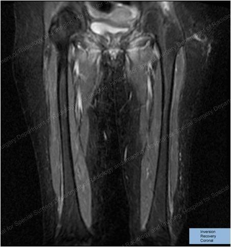 Leg Pain and Weakness in a 22-Year-Old Woman