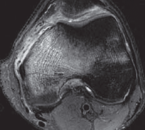 New Support for Bone Marrow Lesions as Predictors in Knee OA