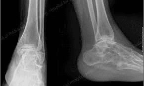 MRIs Detect Sacroiliitis in Juvenile Spondyloarthritis 