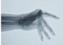 rheumatoid arthritis