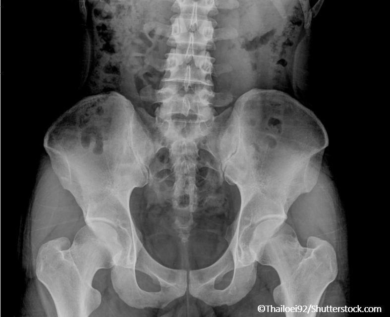 Screening for Osteoporosis May Prevent 25% of Hip Fractures