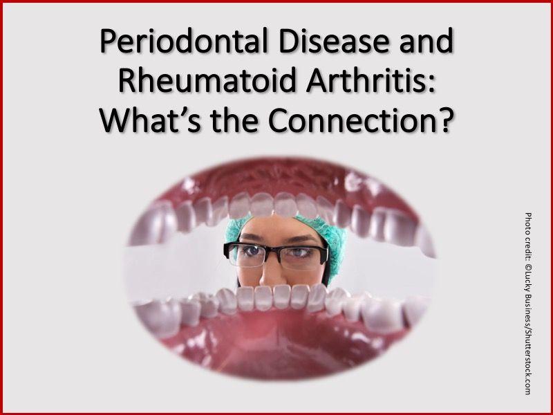 The Link Between Periodontal Disease and Rheumatoid Arthritis