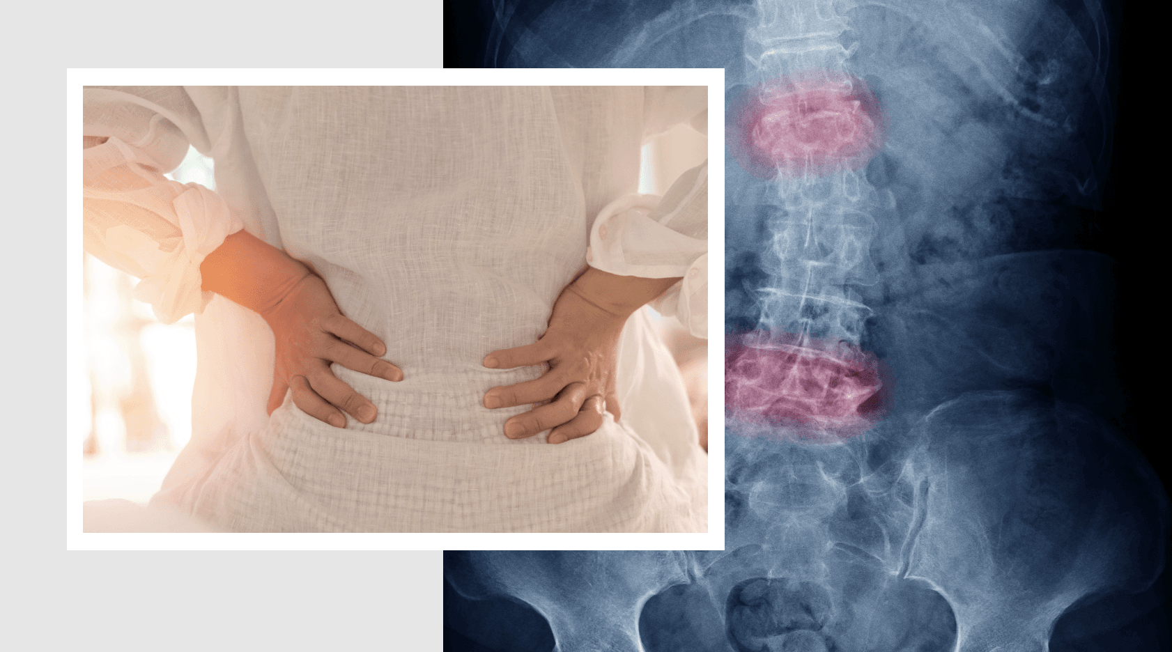 Atul Deodhar, MD, MRCP: Upadacitinib in Active Ankylosing Spondylitis