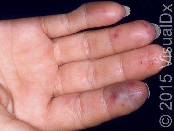 Image IQ: Petechia and Palpable Purpura on the Palms of Hands, Fingers, and Toes