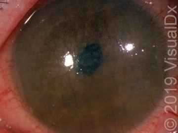 Image IQ:  7-year-old boy with photophobia