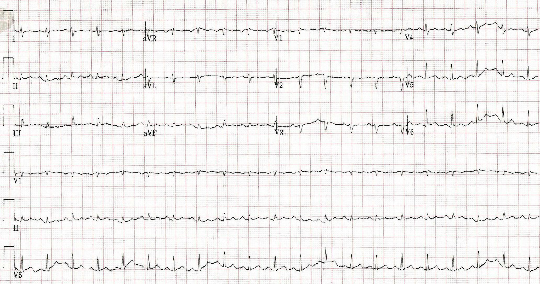 EKG of a patient with tachycardia