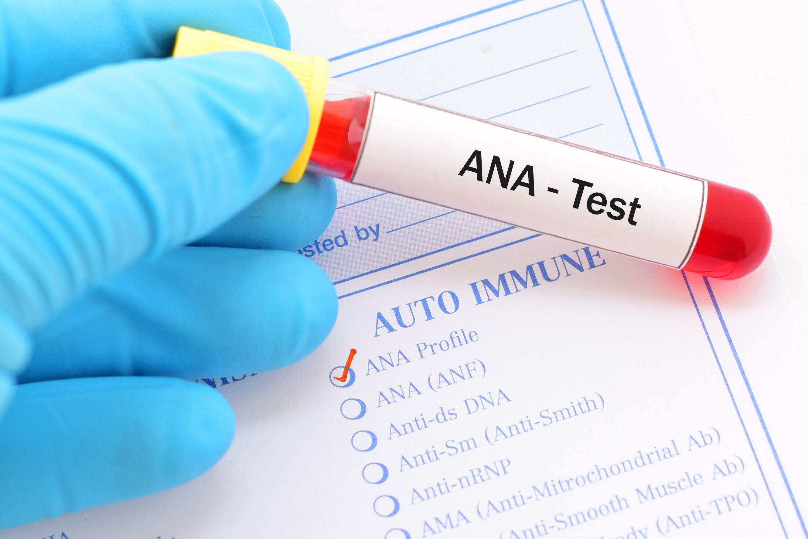 ANA test autoimmune disease