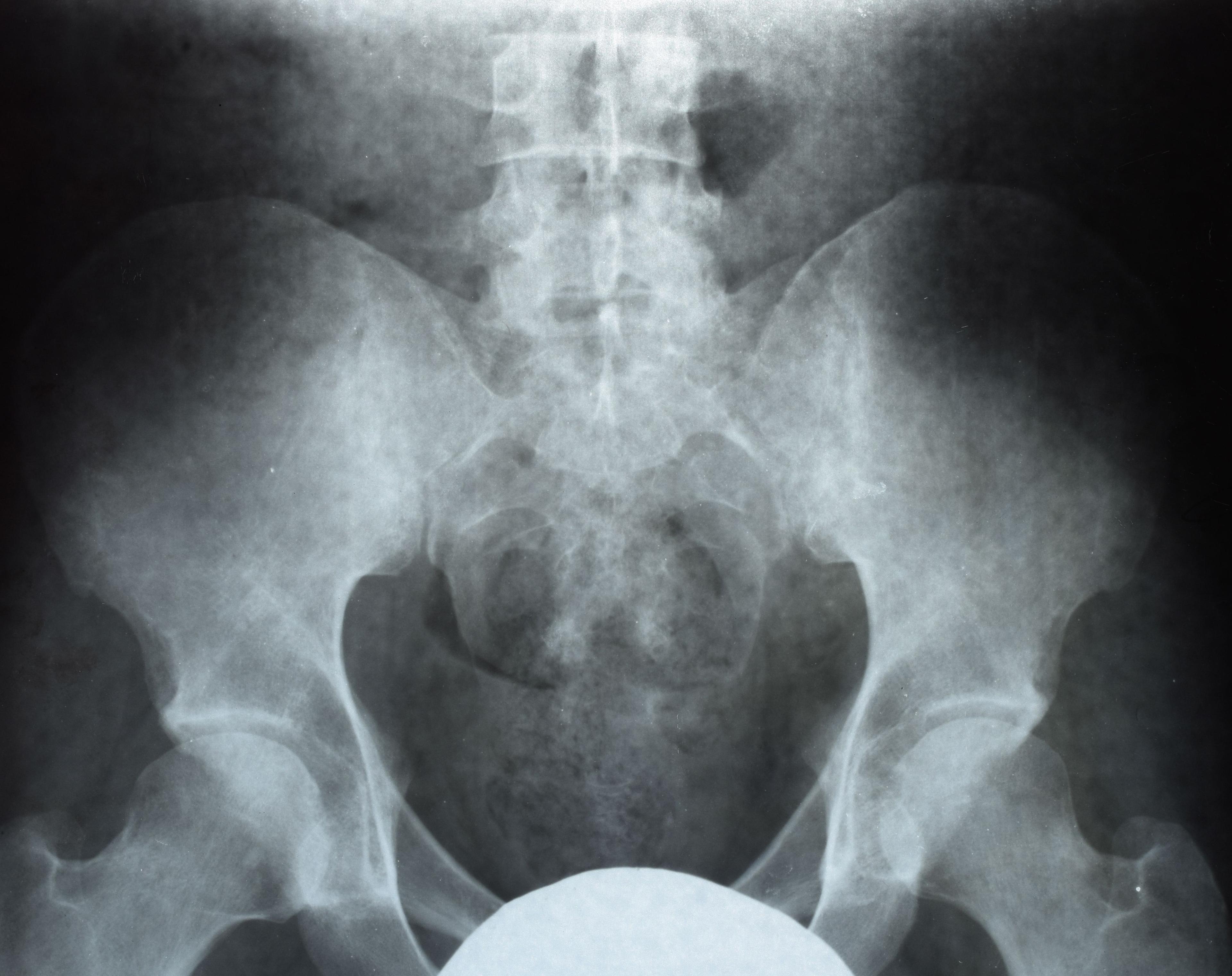 TNFi Dose Reduction Shows No Benefit for Spondyloarthritis 