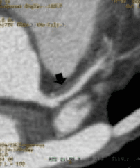 CT angiography