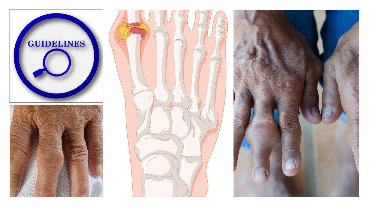 The 2020 Treatment Guidelines for Gout 