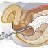 Making Minimally Invasive Surgery Even Less Invasive