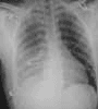 Screen for Latent TB Before and During CZP Treatment