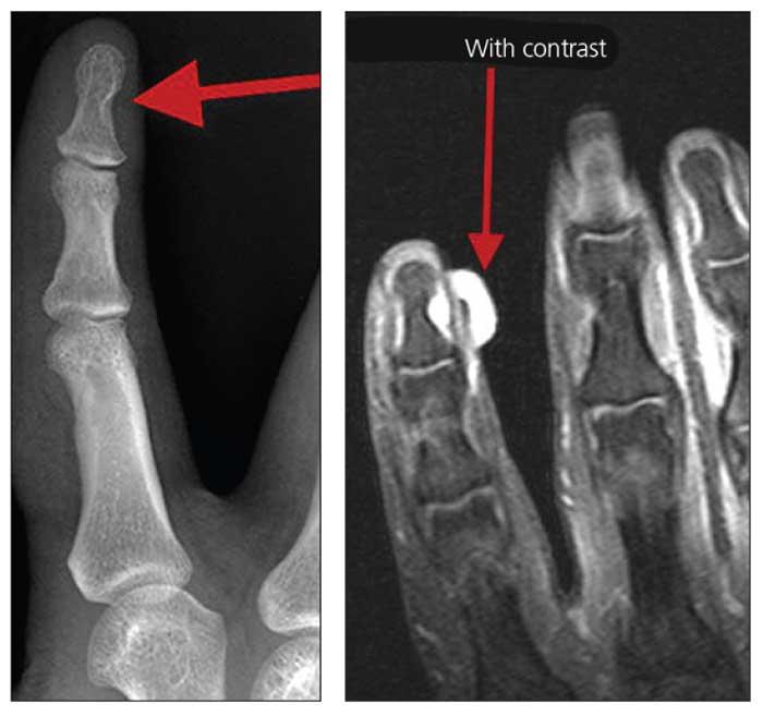 A Man With 10 Years of Exquisite Finger Pain