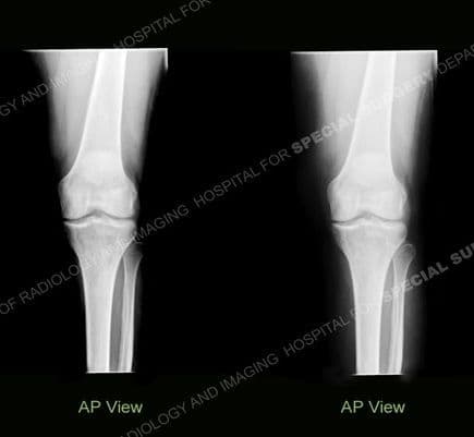 45-Year-Old Woman With Longstanding Knee Pain