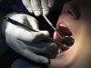 Childhood Oral Infections Associated with Subclinical Atherosclerosis