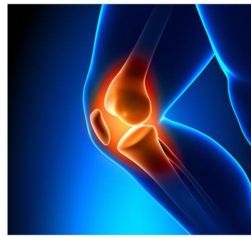 Knee Pain, Not Radiographic Osteoarthritis, Key to Widespread Pain