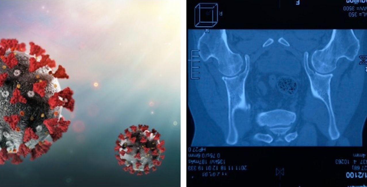 COVID-19, Spondyloarthritis