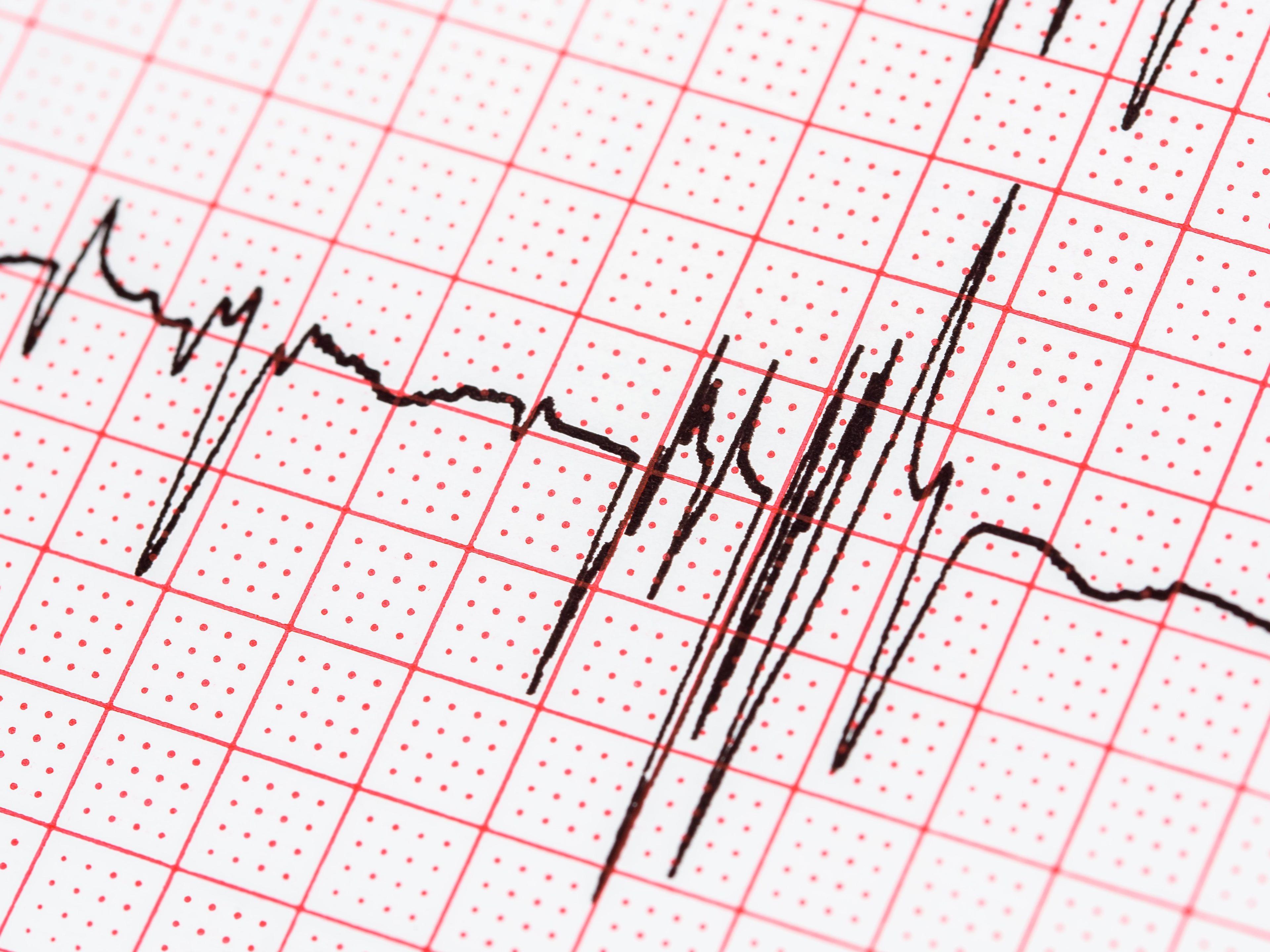 Specific Cancer Types May Carry Increased Risk for Atrial Fibrillation