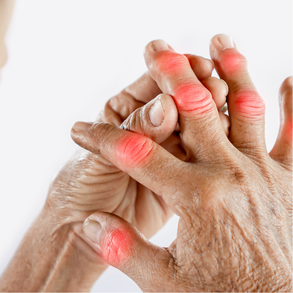 New Research Suggests Molybdenum May Ward Off Hyperuricemia, Gout 