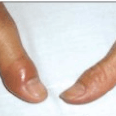 Woman with Suddenly Painful, Swollen Thumb 