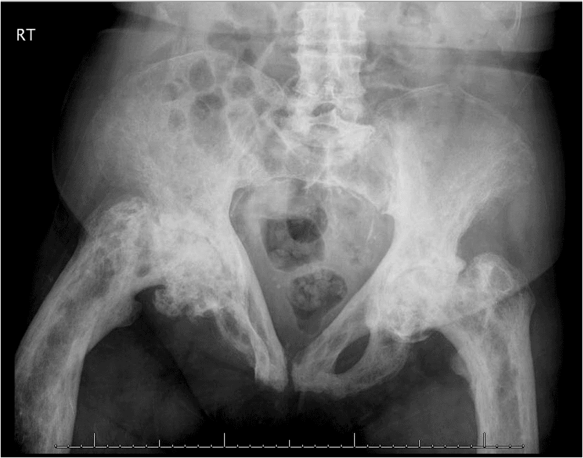 80-Year-Old Woman With Hip Pain