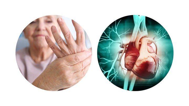 rheumatoid arthritis heart disease