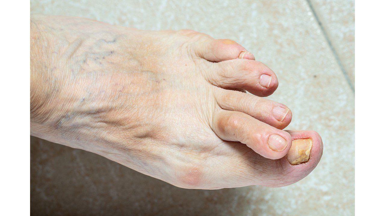 Psoriatic Arthritis Quiz: Monotherapy, Complimentary Medicine and Joint Destruction