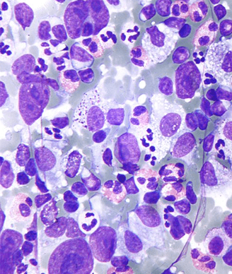 Predicting Lymphoma Risk in Sjögren’s with Salivary Gland Biopsy