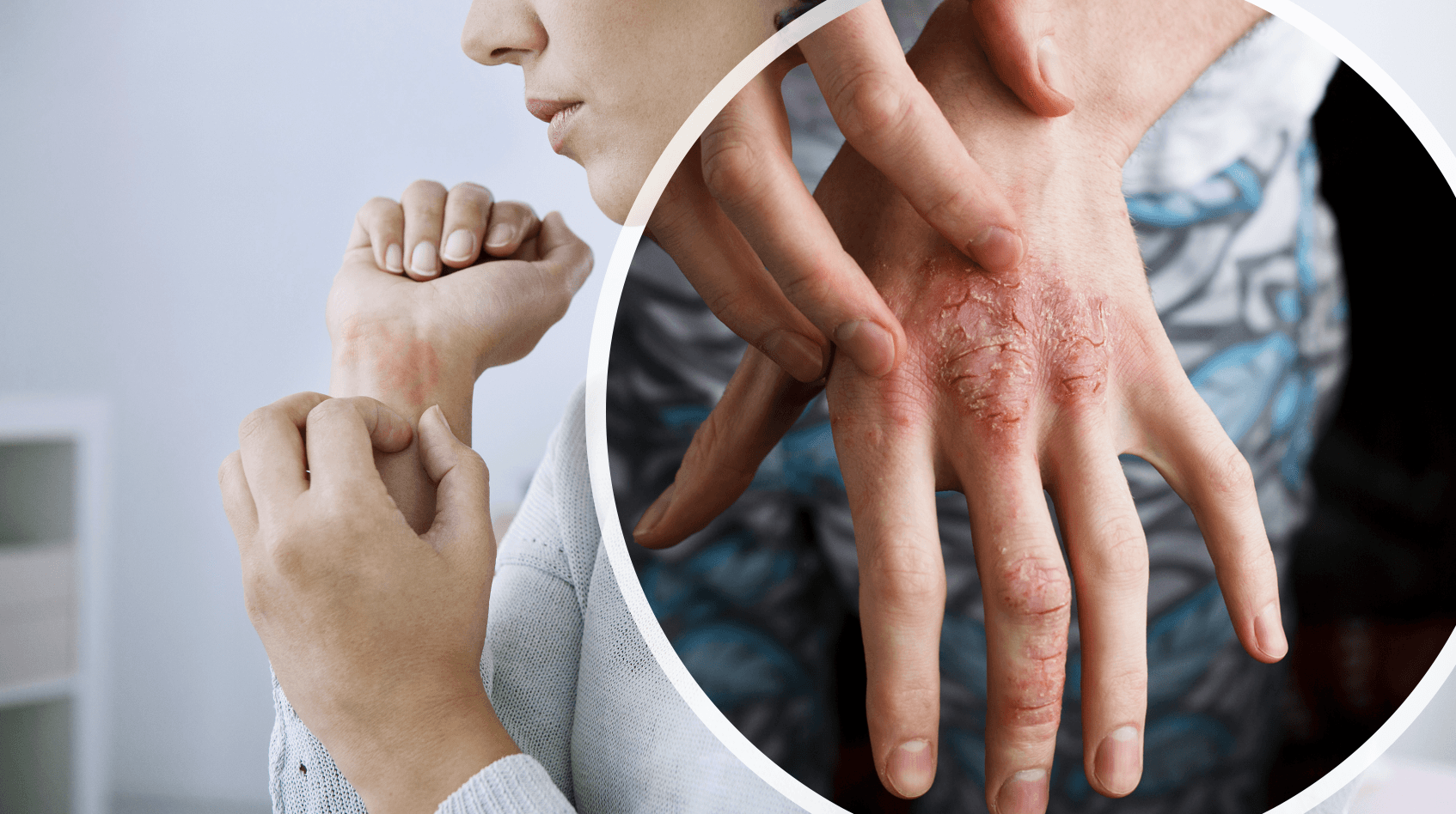 Plaque Psoriasis Treated With Secukinumab Not Affected by Comorbid Psoriatic Arthritis 