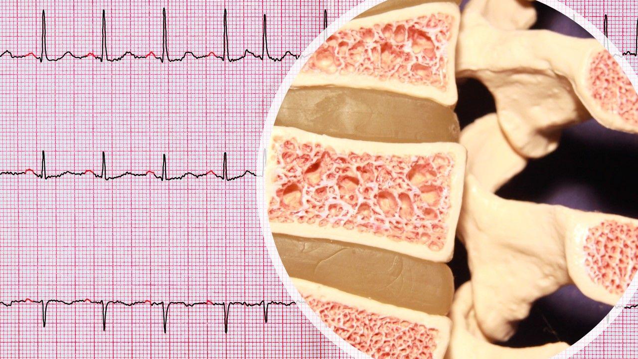 Do bisphosphonates cause atrial fibrillation?