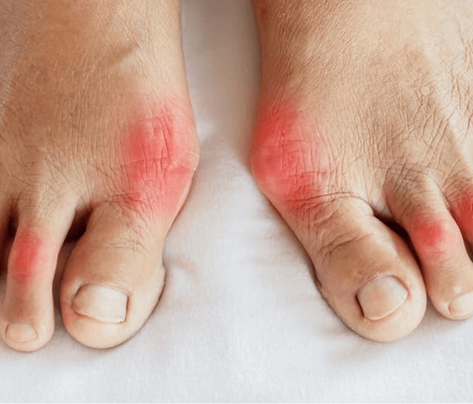 Low Purine Diet Lower Uric Acid in People With Gout 