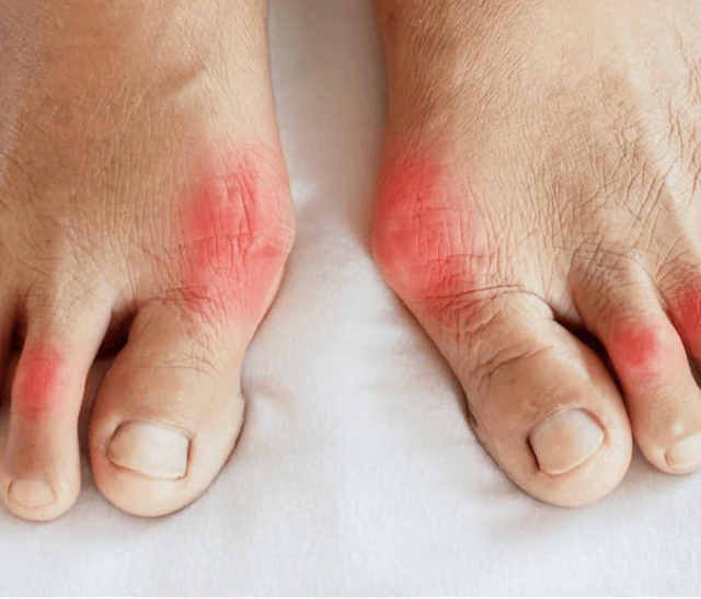 Radiomics Model Distinguishes Gout Flares, May Improve Clinical Decision Making