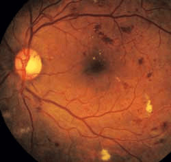 retinopathy