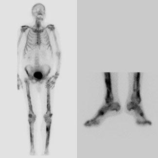 Heavy Smoker With Clubbed Fingers, Pneumonia, and Arthralgias